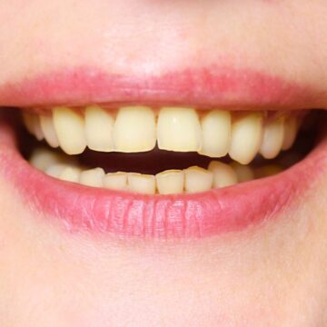 Close-up of stained and crooked teeth