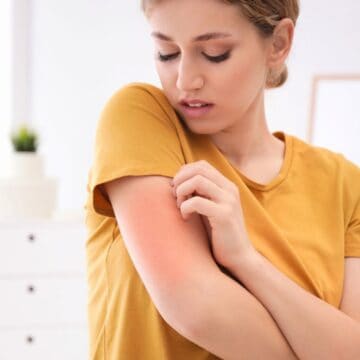A woman wearing a yellow shirt is scratching her right upper arm, which appears red and irritated. She is standing in a bright room with white furniture and green plants in the background.